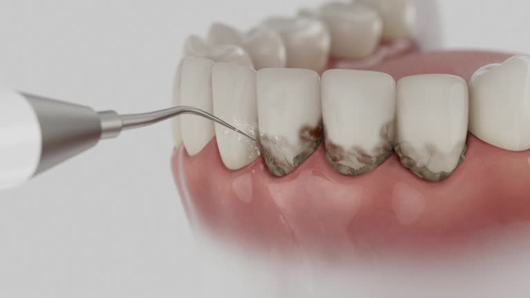 Trusted Wisdom Tooth Removal service in Gallatin, MO - Dentist Open Now